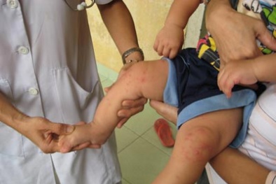 Cảnh báo bệnh tay chân miệng nguy hiểm hơn bệnh sởi